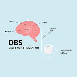 St. Mary's Neurology provides Deep Brain Stimulation (DBS) to patients.