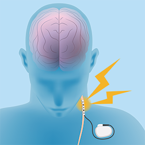 St. Mary's Neurology offers Vagal Nerve Stimulation (VNS) services to patients.